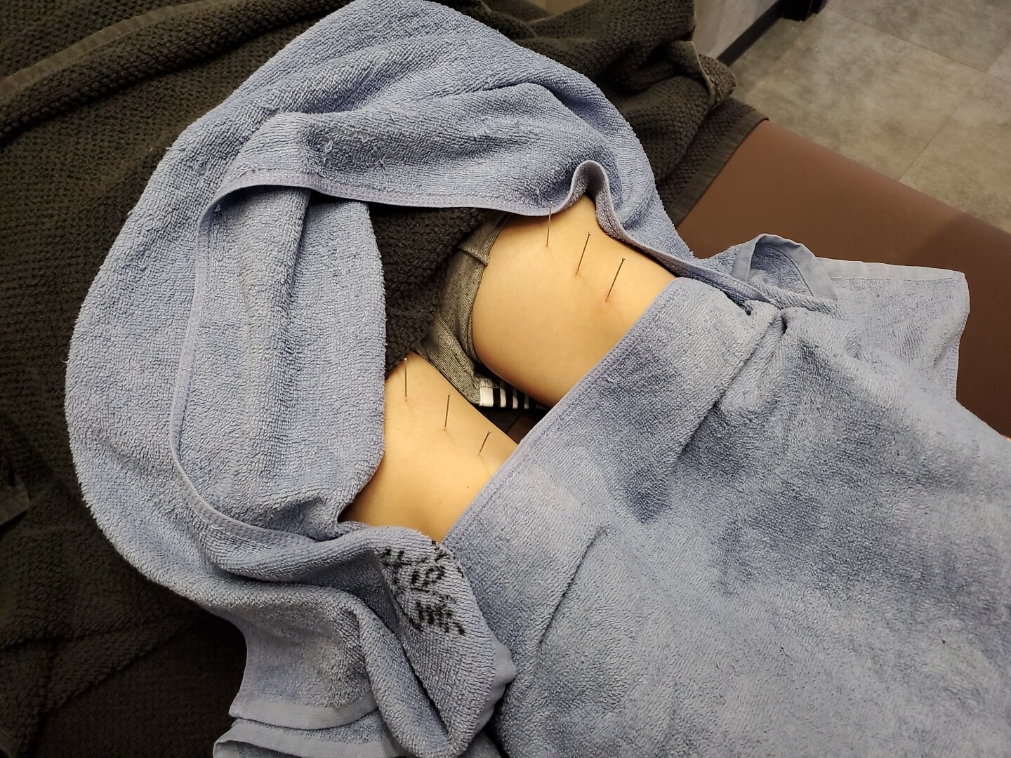 鍼治療、美容鍼もしている、あやめ整骨院です!!
