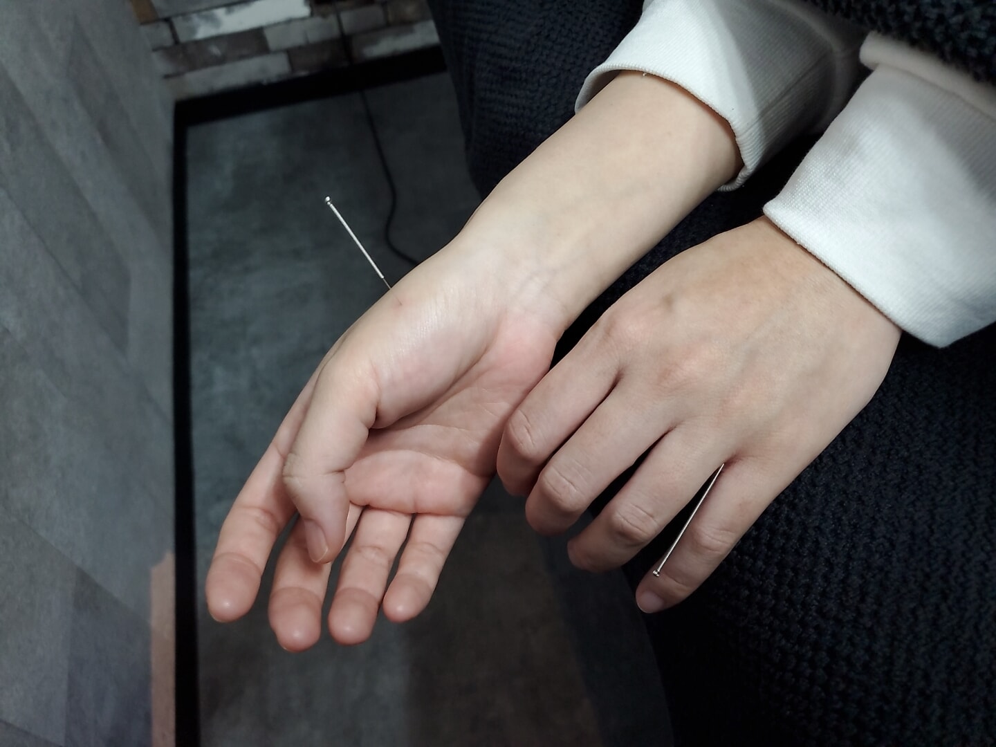 鍼治療、美容鍼もしている、あやめ整骨院です!!